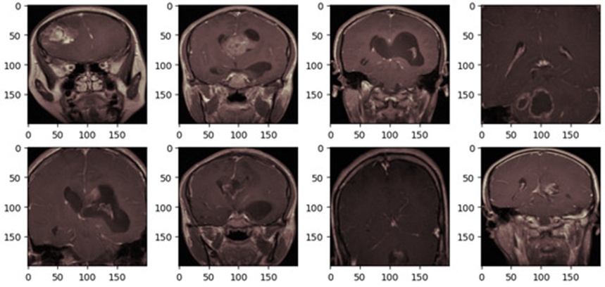 Figure 4. The brain tumor MRI after preprocessing.