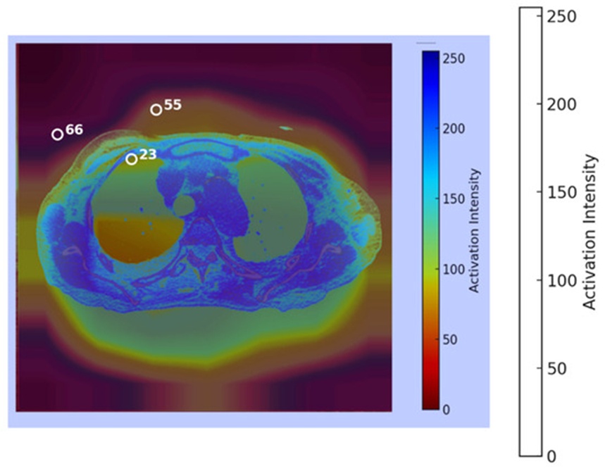 Figure 7. Heatmap of a COVID-19-infected chest generated by the GRAD-CAM model.