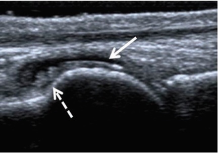 Figure 3. Radiographic appearance of gouty arthritis.
