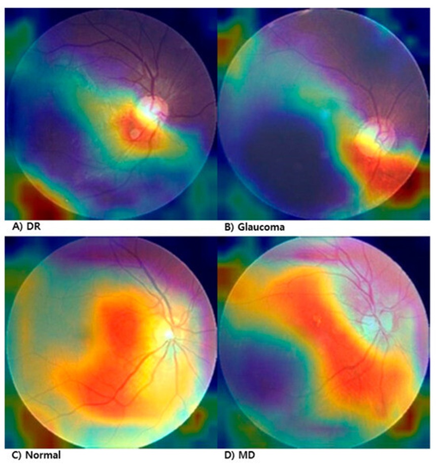 Figure 3. Grad-CAM visualization of manipulated fundus images. (A) Diabetic Retinopathy (DR), (B) Glaucoma, (C) Normal, (D) Macular Degeneration.