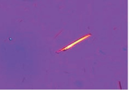 Figure 2. Monosodium urate crystal under polarised light microscopy