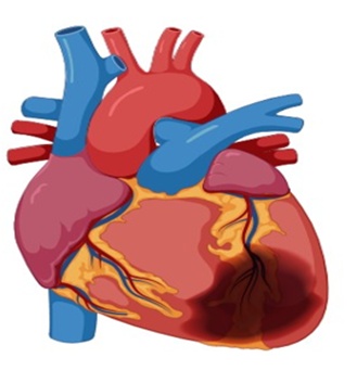 Figure 3. Drug-affected heart.