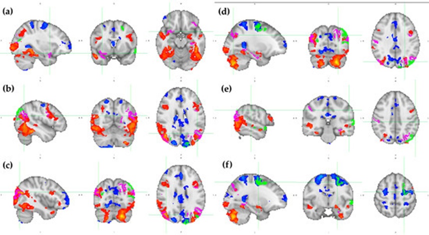 Figure 9. Overlap of the HCP MMP1.0 brain regions with the twenty higher SHAP values modulus (identified in Table 2) over the statistical parametric maps that resulted from the GLM-based analysis. The HCP MMP1.0 brain regions that are more important for mentalizing (mnt) classification are colored in fuchsia, while those that are more important for random (rnd) classification are green. The activations for mentalizing (mnt) classification are colored from red to yellow (2.3 < z < 6.5), while the deactivations for random (rnd) classification are colored from dark to light blue (-2.3 > z > -6.5). Each pane contains a sagittal, coronal, and axial view of (a) x = 32, y = 8, z = -16; (b) x = -46, y = -62, z = 24; (c) x = 42, y = -74, z = 26; (d) x = -26, y = -76, z = 34; (e) x = -56, y = -28, z = 40; and (f) x = -24, y = -8, z = 54. MNI152 standard space. Radiological convention. A: anterior; I: inferior; L: left; P: posterior; R: right; S: superior.