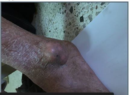 Figure 1. Gouty arthritis.