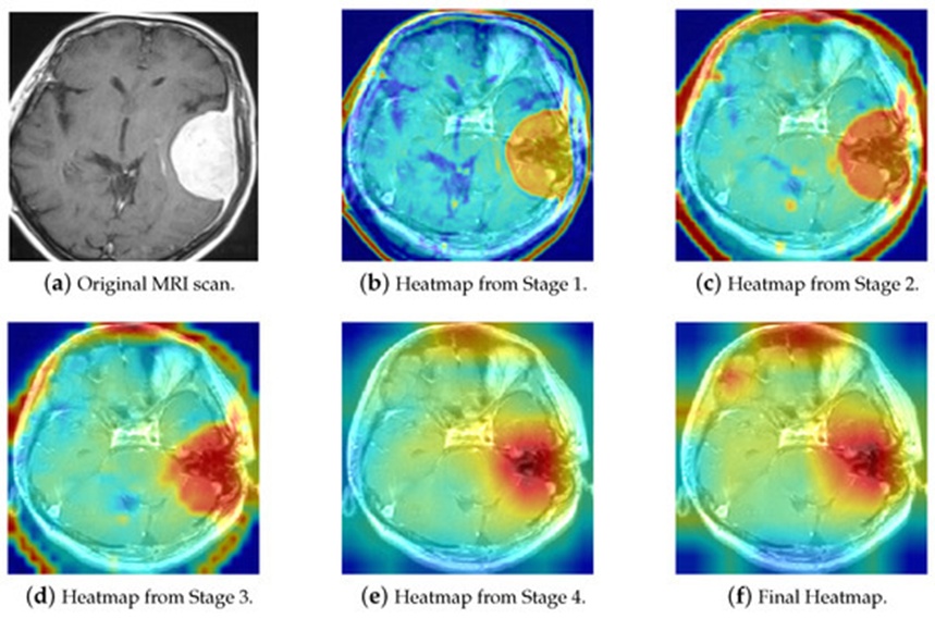 Figure 17. The Grad-CAM visualization of ResNet-50 decision pathways in brain tumor classification.