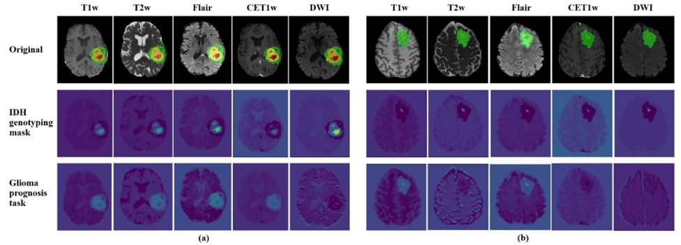 Figure 7. The visualisation results of the method based on multi-modal transformer. (a) UCSF-PDGM-026, Female, IDH-wildtype, high-risk group; (b) UCSF-PDGM-243, male, IDH-mutant, low-risk group.