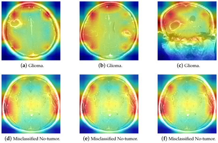 Figure 18. The comparison of Glioma and misclassified No-tumor MRI heatmaps.
