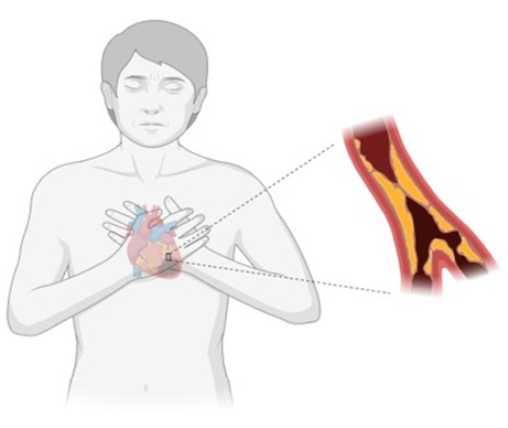Figure 1. Cardiac stroke due to muscle-enhancing drugs.