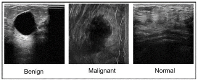 Figure 2.  Sample ultrasound images of the BUSI dataset. BUSI, breast ultrasound imaging dataset.