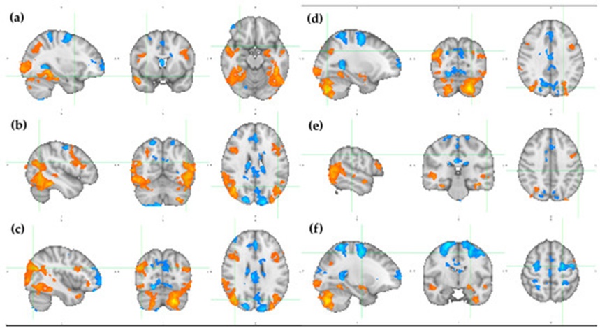 Figure 8. Statistical parameter maps resulting from the GLM-based analysis over the ICBM152 brain template. The activations for mentalizing (mnt) classification are colored from red to yellow (2.3 < z < 6.5), while the deactivations for random (rnd) classification are colored from dark to light blue (-2.3 > z > -6.5). Each pane contains a sagittal, coronal, and axial view of (a) x = 32, y = 8, z = -16; (b) x = -46, y = -62, z = 24; (c) x = 42, y = -74, z = 26; (d) x = -26, y = -76, z = 34; (e) x = -56, y = -28, z = 40; and (f) x = -24, y = -8, z = 54. MNI152 standard space. Radiological convention. A: anterior; I: inferior; L: left; P: posterior; R: right; S: superior.