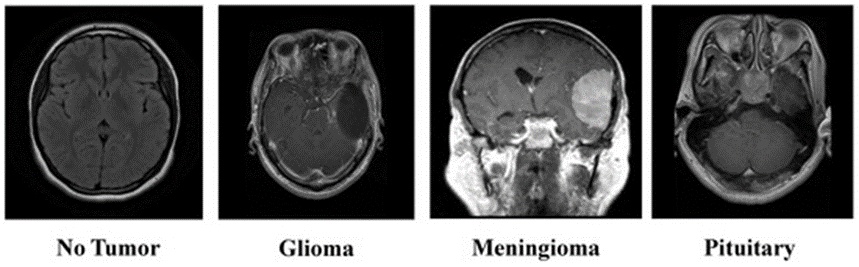 Figure 2. Overview of the brain tumor MRI dataset.