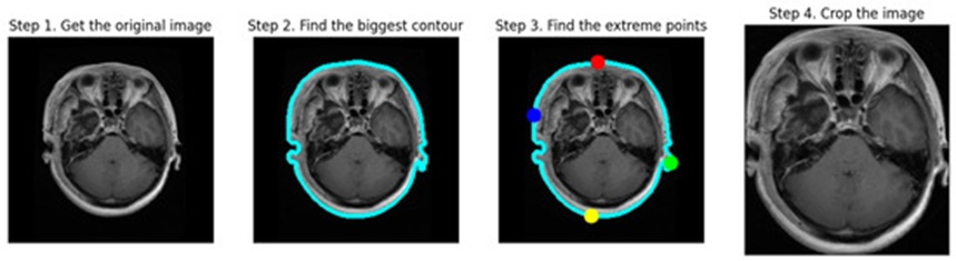 Figure 3. The cropping process of MRI scans.