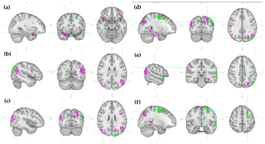 Figure 7. HCP MMP1.0 brain regions with the twenty higher SHAP values modulus (identified in Table 2) depicted over the ICBM152 brain template. The brain regions that are more important for mentalizing (mnt) classification are colored in fuchsia, while those that are more important for random (rnd) classification are green. Each pane contains a sagittal, coronal, and axial view of (a) x = 32, y = 8, z = −16; (b) x = −46, y = −62, z = 24; (c) x = 42, y = −74, z = 26; (d) x = −26, y = −76, z = 34; (e) x = −56, y = −28, z = 40; and (f) x = −24, y = −8, z = 54. MNI152 standard space. Radiological convention. A: anterior; I: inferior; L: left; P: posterior; R: right; S: superior.