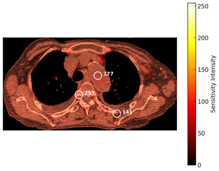Figure 6. Heatmap of a COVID-19-infected chest generated by the PLI model.